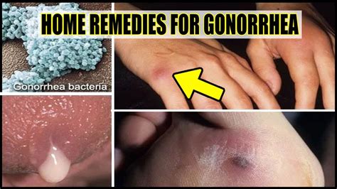 Remedio Para Gonorreía Homem - Remedio Caseiro Para Gonorreía - RETOEDU