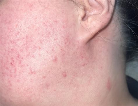 PICTURE ⚠️ - what are these bumps on my face!! : r/Celiac