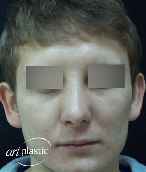 Кривой, горбатый нос / Фото / Альбом №2 | Клиника Art-Plastic