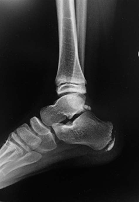 ankle musculoskeletal key