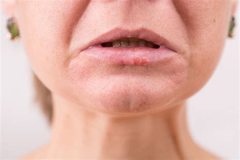 Principales enfermedades que sufren los labios