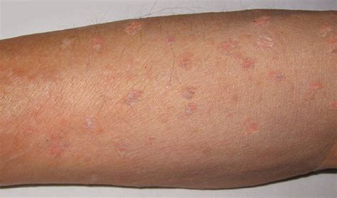Leukemia Symptoms Skin