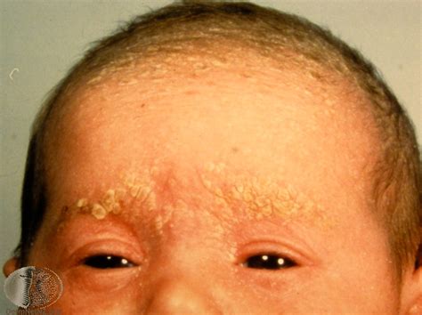 cradle cap  babies london  symptoms treatment