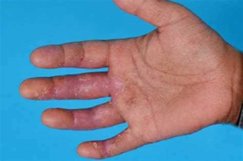 Dyshidrotic Eczema Arm