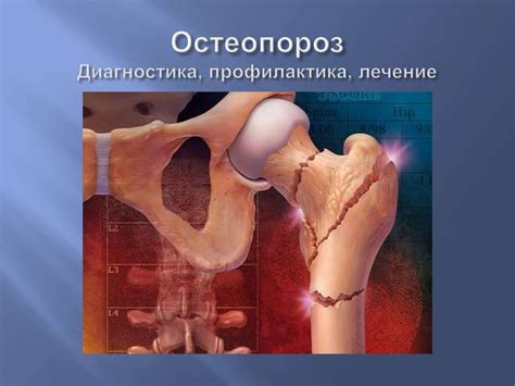 Остеопороз. Диагностика, профилактика, лечение - презентация онлайн
