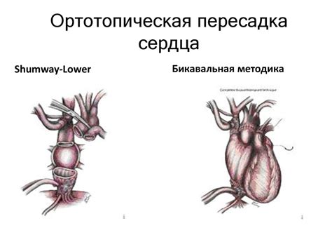 Трансплантация сердца - презентация онлайн