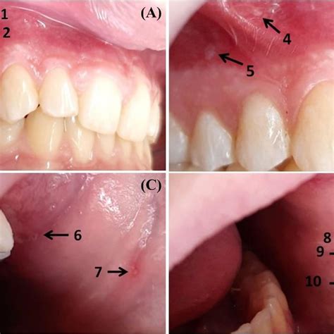 Primary herpetic gingivostomatitis. | Download Scientific Diagram