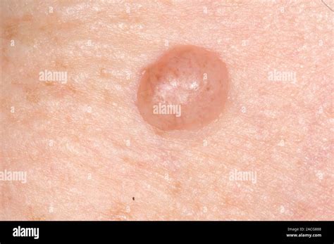 close    mole naevus   skin   adult patient forming