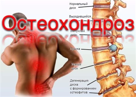 Остеохондроз - признаки, причины, симптомы, лечение и профилактика ...