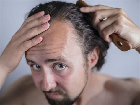 Testosterone and Hair Loss: Is There a Connection?