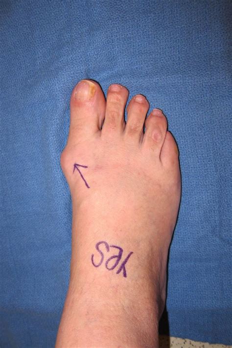 before and after bunionectomy surgery Archives - City Footcare NYC ...