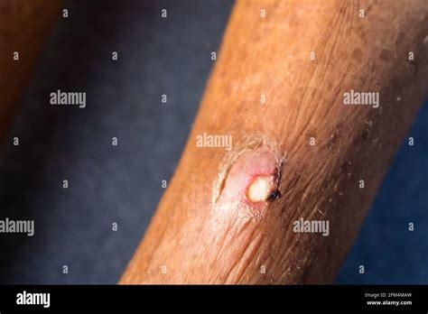 A close up shot of an infected boil filled with pus inside on the leg ...