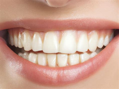 how to reverse cavities 5