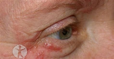Periocular dermatitis image