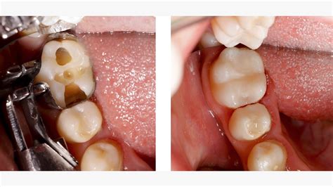 Cavity Before And After Filling