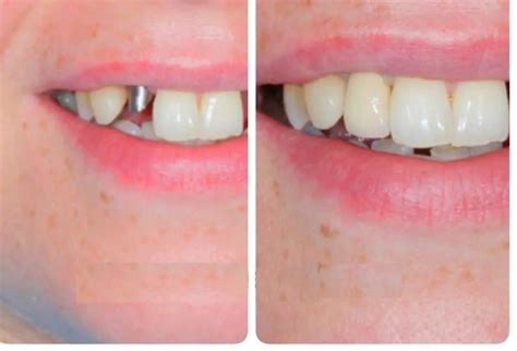 Denticum