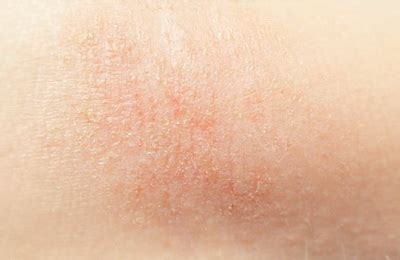 Dermatitis atópica en las piernas photo