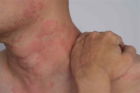 Why Do I Have a Rash on My Neck?