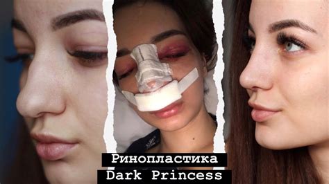 РИНОПЛАСТИКА DARK PRINCESS | одна в Ереване | ДО и ПОСЛЕ - YouTube