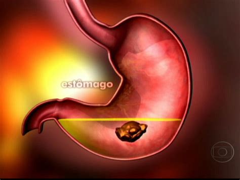Infecção No Estômago E Grave - Vídeo: Gastrite é uma inflamação da parede do estômago | RJ1 | G1