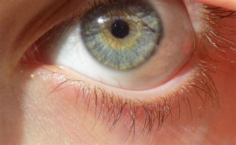 central heterochromia  center   eye  yellowbrown