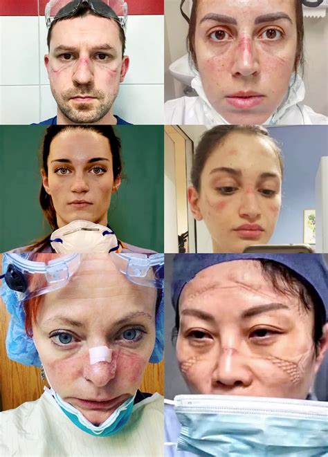 Faces of healthcare workers after long shifts wearing masks : r/pics