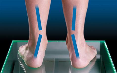 pie pronador fisiomarket | Blog de fisioterapia