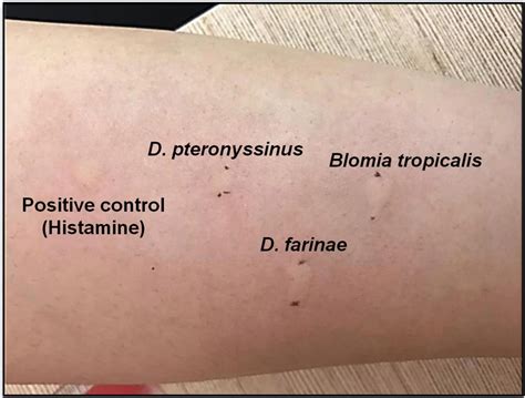 Histamine Reaction On Skin