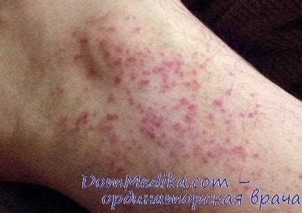 Диференциална диагноза на кожни обриви