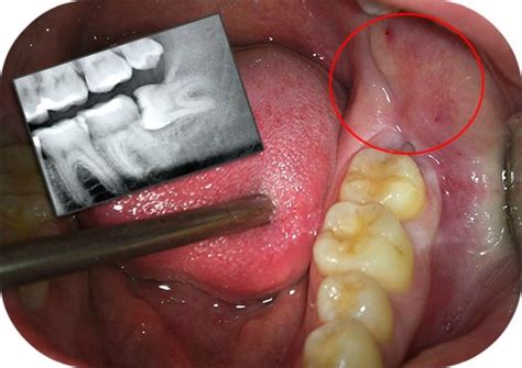 Зуб мудрості росте і болить ясна: що робити, як зняти біль | Dental Art