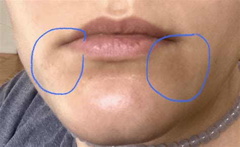 Need help with irritation around mouth : r/tretinoin