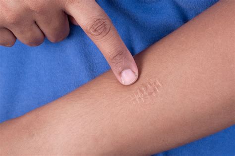 Scars and Skin Tones: How Scars Affect Different Skin Types - Scarfade