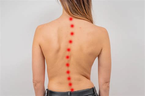 Can Scoliosis Cause Headaches? - OrthoAdvanced & Spine