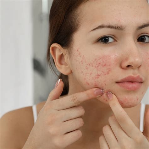 Acne Prone Skin | Glamour Glow