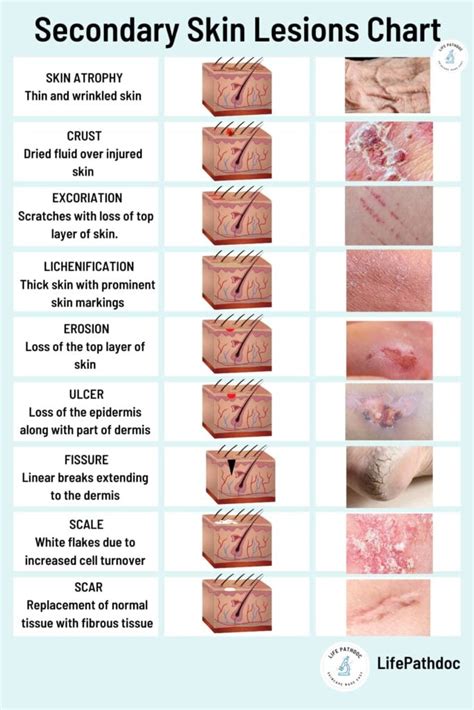 skin lesions types  chart pictures  treatment