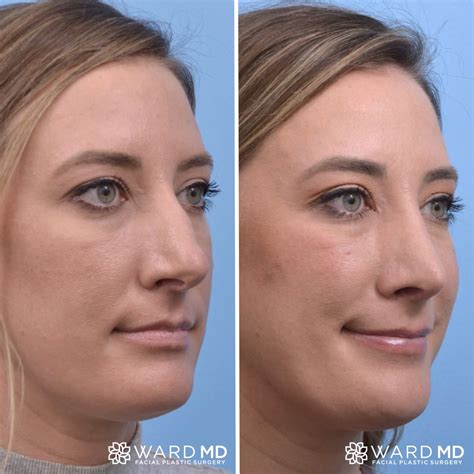 pin   p  nose job face surgery nose job rhinoplasty