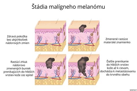 Malígny melanóm - príznaky a liečba