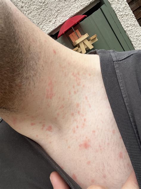 Help! Sudden rash : r/Dermatology