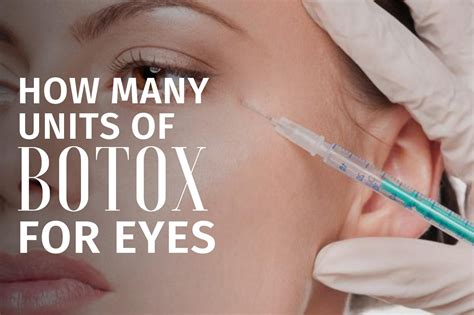 How Many Units Of Botox For Eyes - Fitness Beauty Art