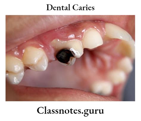 Dental Caries Question And Answers - Class Notes
