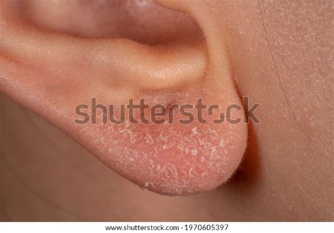 Skin Disease Eczema Dermatology Problems Blisters Stock Photo 1970605397 | Shutterstock