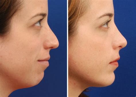11 Different Types of Chin Shapes: Cleft, Receding, Double, Pointy ...