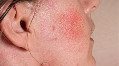 Ivermectin and Rosacea: What You Need to Know | Gladskin