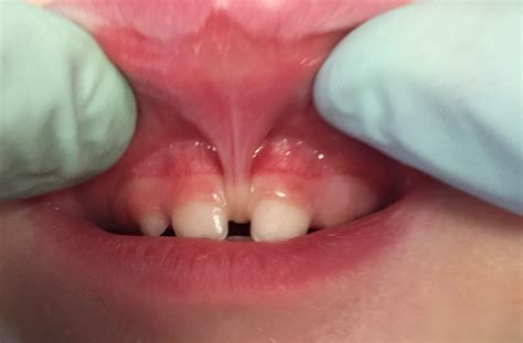 The Importance of the Labial Frenum — Hygiene Edge | Style definition ...