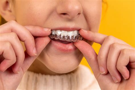 Retainer Types: Bonded, Hawley and Clear Retainers