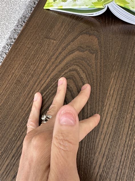 Fingernail problems - #10 by galdiolus - Top tips and practical support