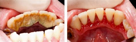 Who Needs Full Mouth Debridement?