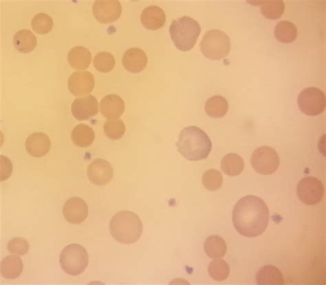 Howell-Jolly bodies - Medicine Question Bank