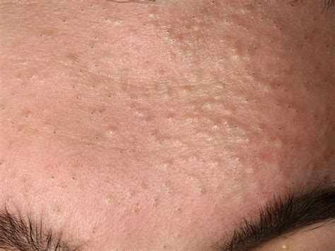 white head bumps