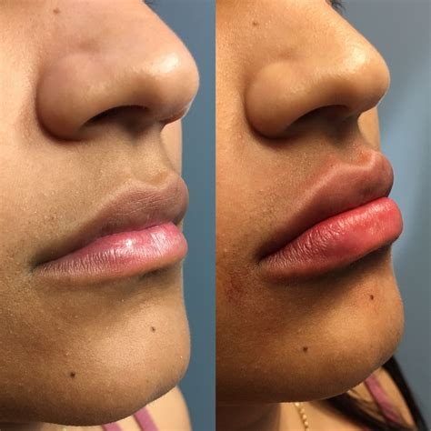 Pout Lips Surgery | Lipstutorial.org